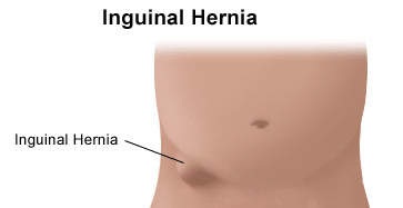 Hernia inghinala localizare